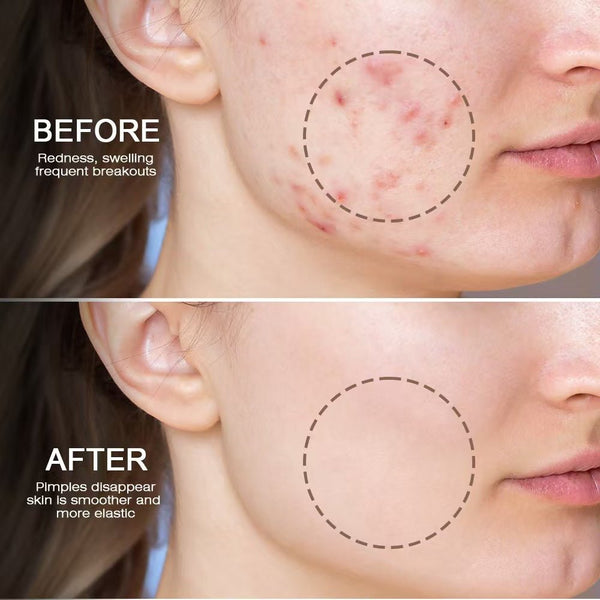 Bee Anti-Acne Gel (Original